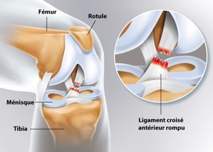 Ligament croisé 